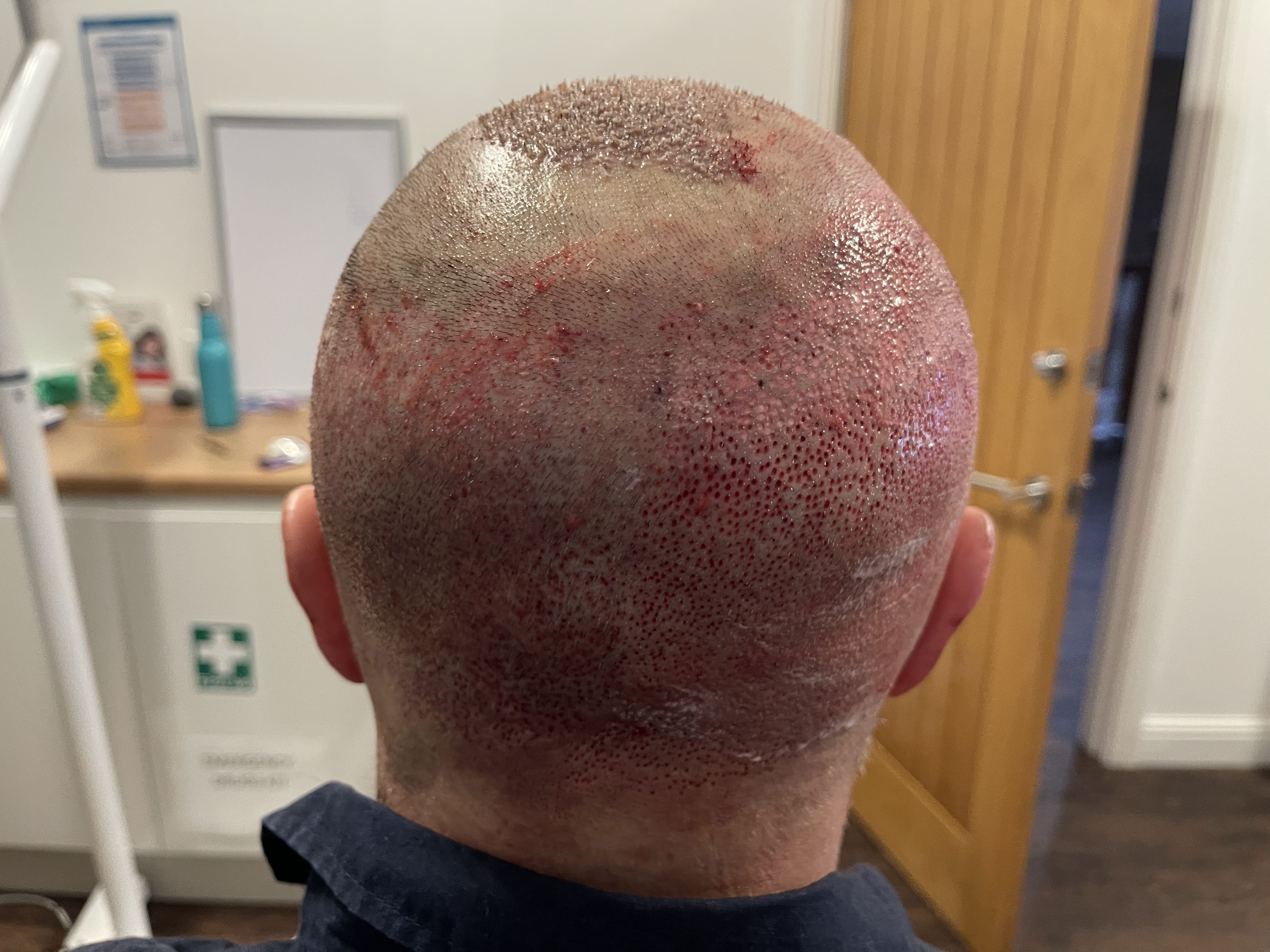 Norwood 7 hair transplant — Colin result photo 6